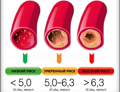 Высокий холестерин: два основных симптома в руках и ногах