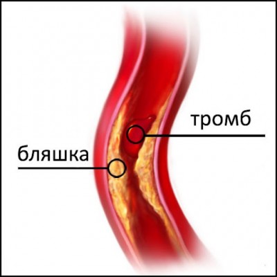 Атеросклероз