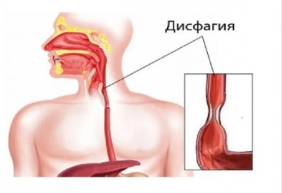 Затрудненное  глотание (дисфагия)