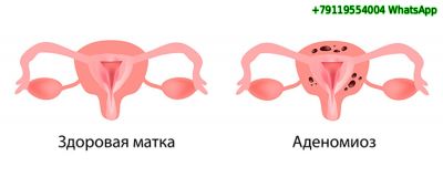 Аденомиоз - Симптомы и причины