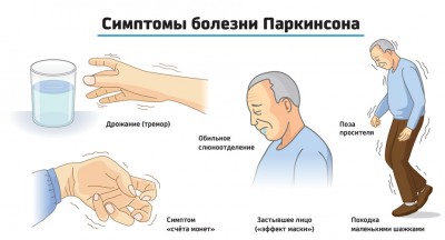 Болезнь Паркинсона: симптомы, стадии, диагностика