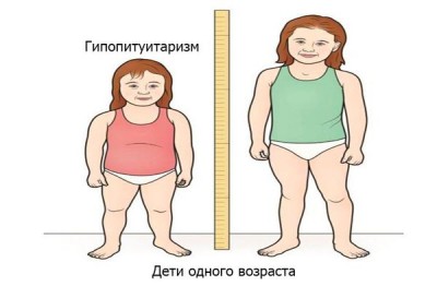 Гипопитуитаризм