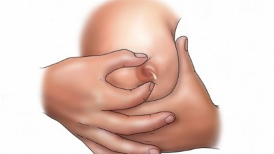 Галакторея , причины, симптомы, диагностика и лечение