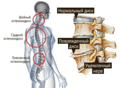 остеохондроз давайте узнать