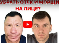 Причина почему развивается отек лица и рук?