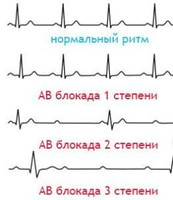 Атриовентрикулярной блокады (АВ-блокада)