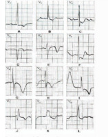 Изменения зубца Т и их причины